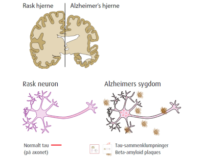 Analyse av Alzheimer-risikofaktorer